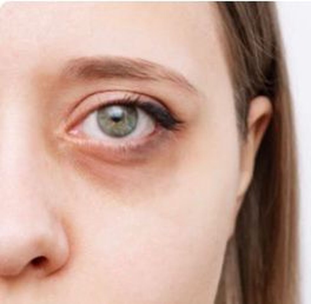 Conheça as 6 principais causas de olheiras