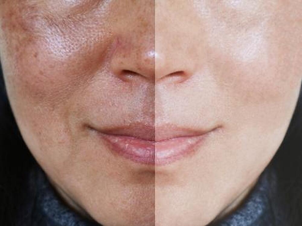 Desvendando as Sombras da Pele: A Batalha Contra o Melasma e a Busca pela Essência Perdida