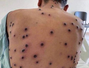 OMS declara mpox como emergência em saúde pública global