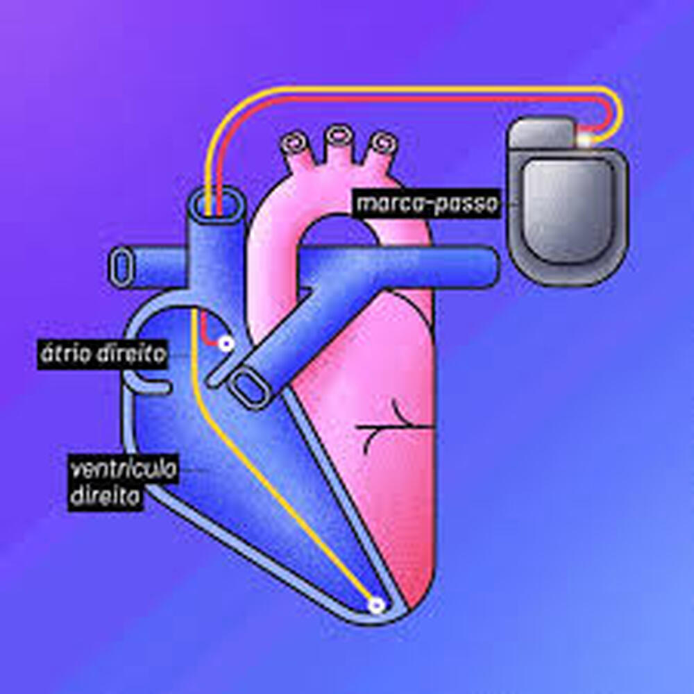 Marcapasso feito com IA que reduz em 50% os sintomas do Parkinson