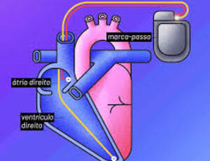 Marcapasso feito com IA que reduz em 50% os sintomas do Parkinson