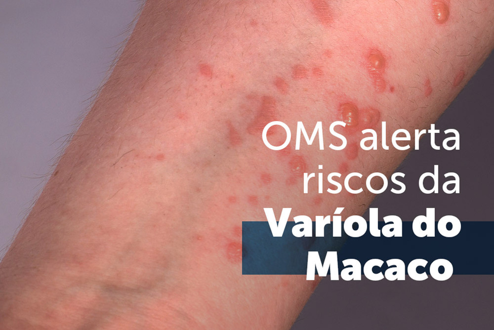 Surto de Mpox no Rio de Janeiro Alcança Níveis Alarmantes: Mais de 3 Mil Notificações e 1.266 Casos Confirmados com 7 Novos Casos em Agosto