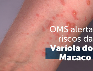 Surto de Mpox no Rio de Janeiro Alcança Níveis Alarmantes: Mais de 3 Mil Notificações e 1.266 Casos Confirmados com 7 Novos Casos em Agosto