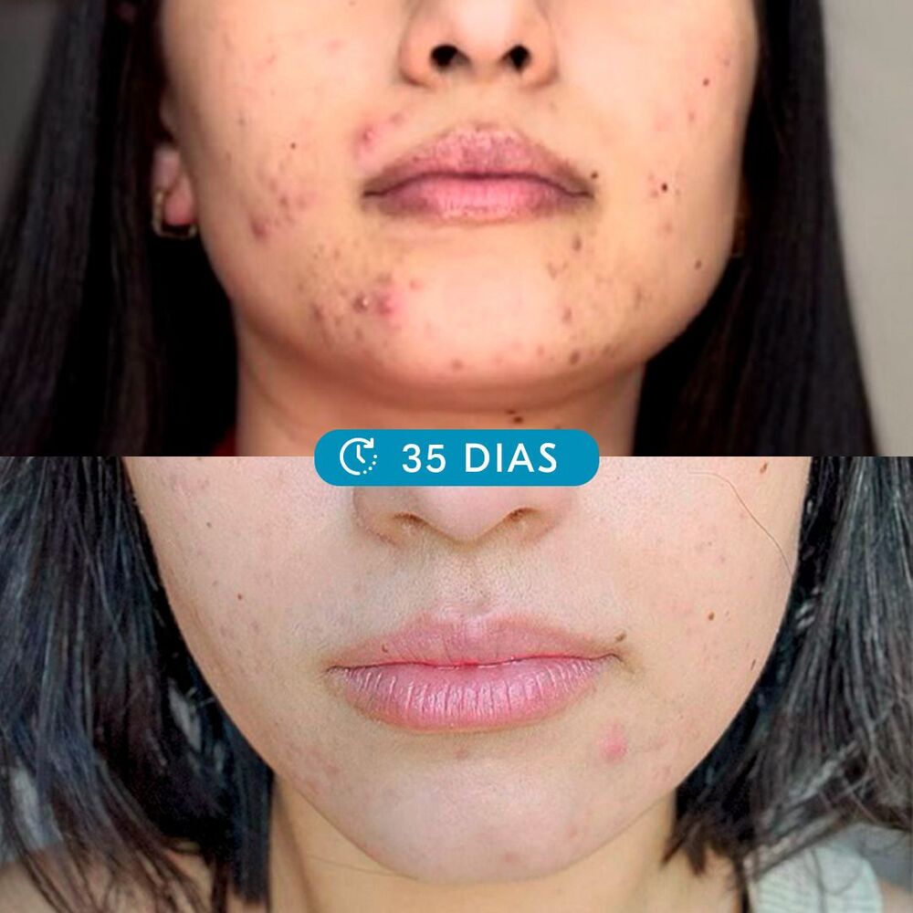 UFMG desenvolve tecnologia inédita para combate à acne com eficácia comprovada em estudo clínico